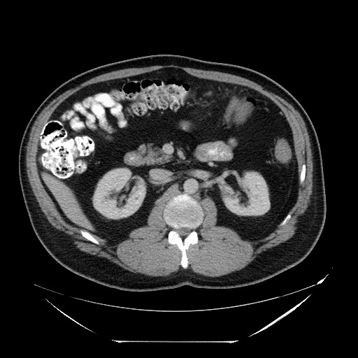 Colocolic intussusception due to lipoma (Radiopaedia 73712-84508 A 46).jpg