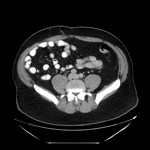 Colocolic intussusception due to lipoma (Radiopaedia 73712-84508 A 77).jpg
