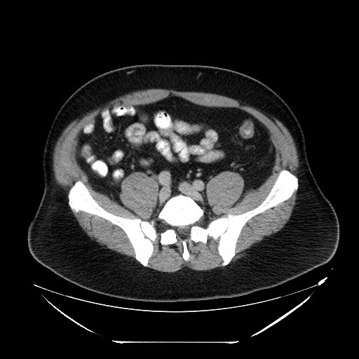File:Colocolic intussusception due to lipoma (Radiopaedia 73712-84508 Axial 83).jpg