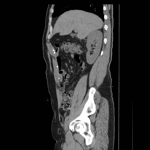 File:Colocutaneous fistula in Crohn's disease (Radiopaedia 29586-30093 C 7).jpg