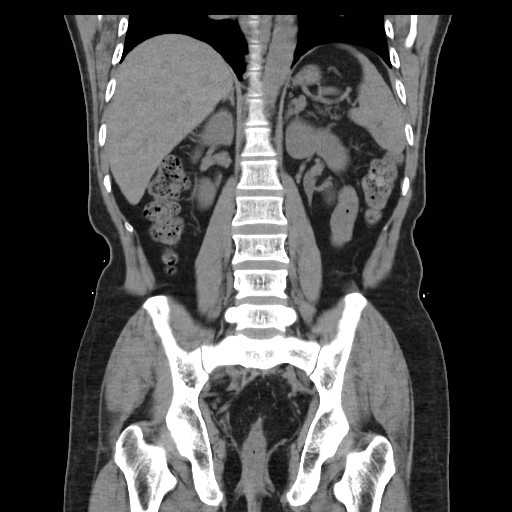 File:Colocutaneous fistula in Crohn's disease (Radiopaedia 29586-30093 Coronal non-contrast 26).jpg