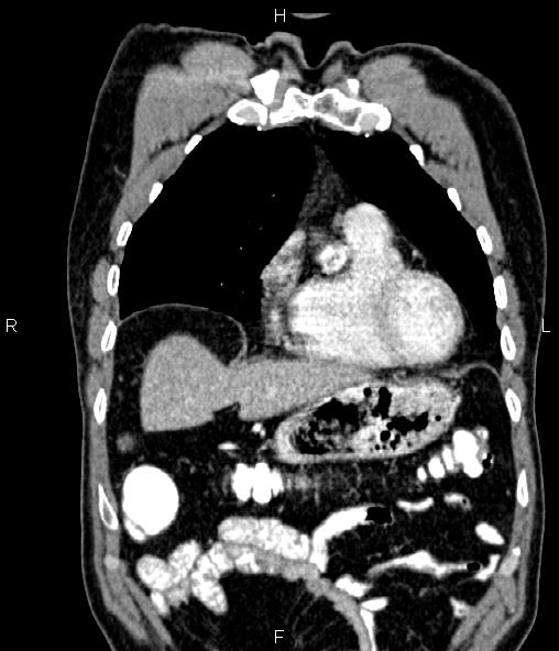 Colon adenocarcinoma (Radiopaedia 83266-97671 C 17).jpg