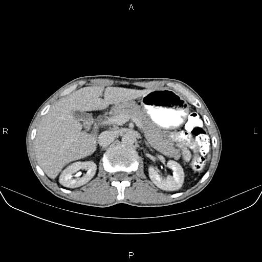 File:Colon adenocarcinoma - hepatic flexure (Radiopaedia 85635-101395 Axial C+ delayed 28).jpg