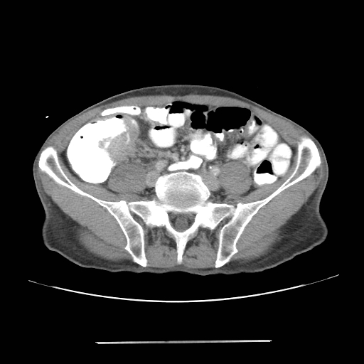 File:Colon cancer with calcified liver metastasis (Radiopaedia 74423-85307 A 53).jpg