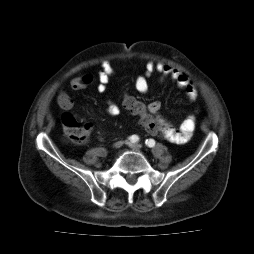 File:Colon cancer with duodenal invasion (Radiopaedia 16278-15958 A 43).jpg