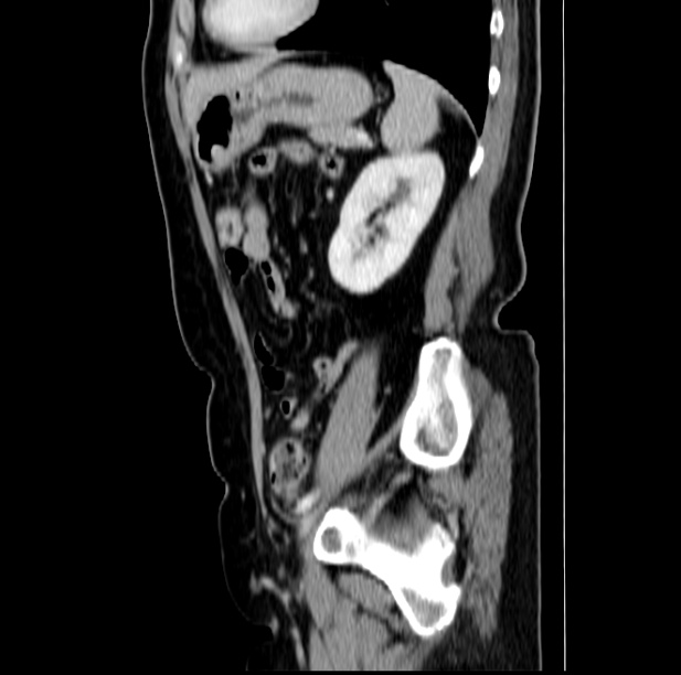 Colon carcinoma with hepatic metastases (Radiopaedia 29477-29961 C 40).jpg