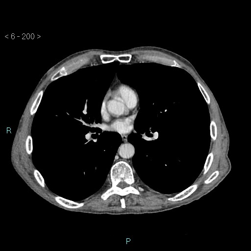 File:Colonic cancer (ultrasound and TC imaging) (Radiopaedia 50346-55713 B 200).jpg