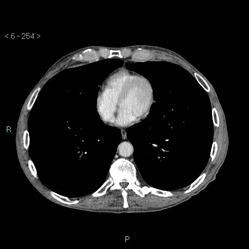 File:Colonic cancer (ultrasound and TC imaging) (Radiopaedia 50346-55713 B 254).jpg