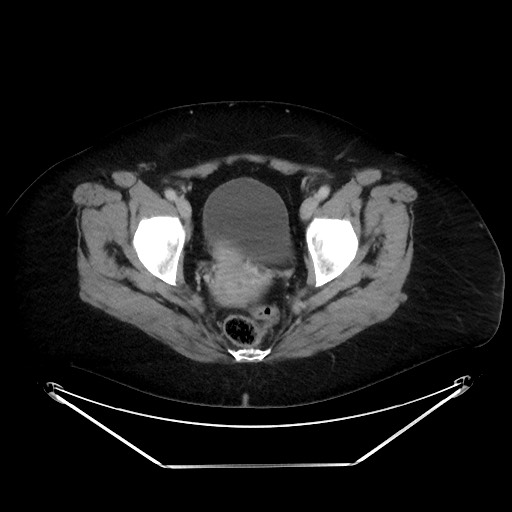 File:Colonic intussusception due to adenocarcinoma (Radiopaedia 86828-102987 A 134).jpg