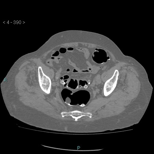 File:Colonic lipomas (Radiopaedia 49137-54244 Axial bone window 174).jpg