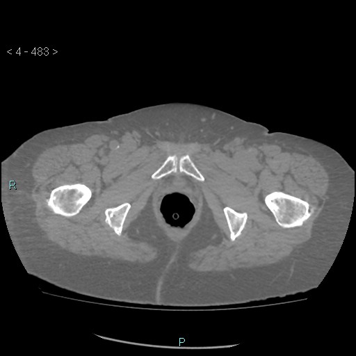 Colonic lipomas (Radiopaedia 49137-54244 Axial bone window 215).jpg
