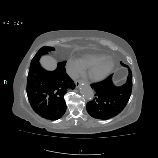 File:Colonic lipomas (Radiopaedia 49137-54244 Axial bone window 24).jpg