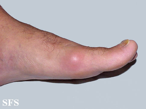 File:Gout (Dermatology Atlas 1).jpg