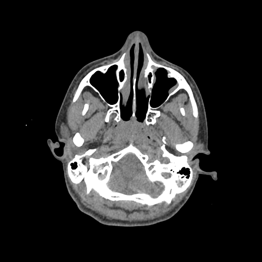 File:Nasal pyogenic granuloma (lobular capillary hemangioma) (Radiopaedia 85536-101244 Axial non-contrast 51).jpg