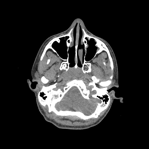 Nasal pyogenic granuloma (lobular capillary hemangioma) (Radiopaedia 85536-101244 Axial non-contrast 60).jpg