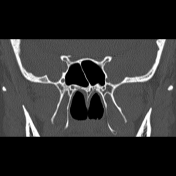 File:Nasal septal perforation (Radiopaedia 25030-25289 Coronal bone window 55).jpg