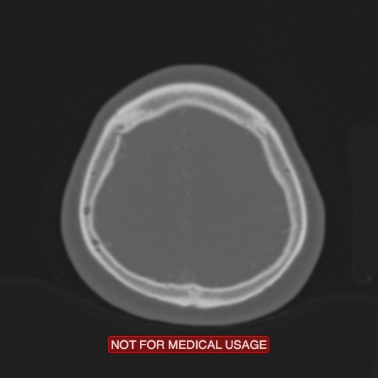Nasopharyngeal carcinoma recurrence - skull base destruction (Radiopaedia 29107-29490 Axial bone window 19).jpg