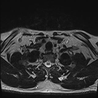 Nasopharyngeal carcinoma with perineural spread (Radiopaedia 55030-61380 Axial T2 83).jpg