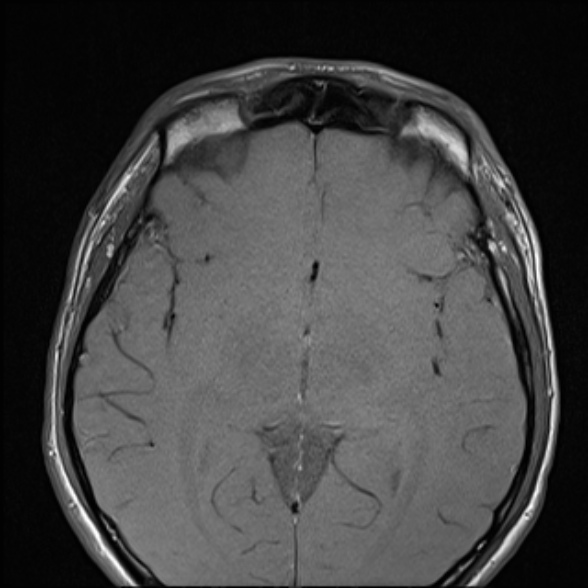 Nasopharyngeal carcinoma with skull base invasion (Radiopaedia 53415-59485 Axial T1 10).jpg
