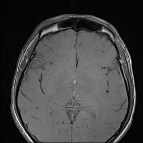 Nasopharyngeal carcinoma with skull base invasion (Radiopaedia 53415-59485 Axial T1 9).jpg