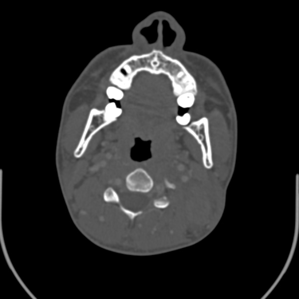 Nasopharyngeal carcinoma with skull base invasion (Radiopaedia 53415-59705 Axial bone window 92).jpg
