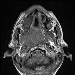 Nasopharyngeal carcinoma with skull base invasion (Radiopaedia 59258-66600 B 23).jpg