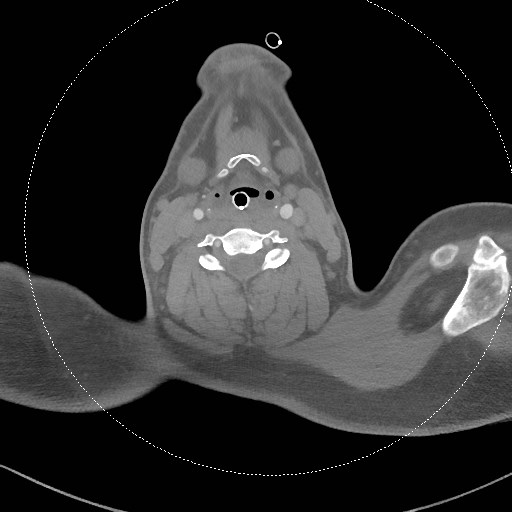 Neck CT angiogram (intraosseous vascular access) (Radiopaedia 55481-61945 B 176).jpg