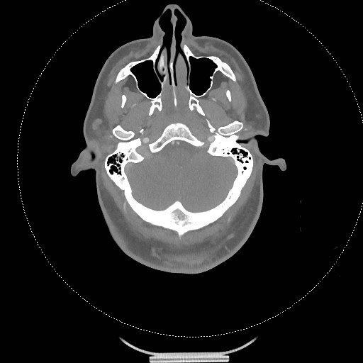 Neck CT angiogram (intraosseous vascular access) (Radiopaedia 55481-61945 B 260).jpg