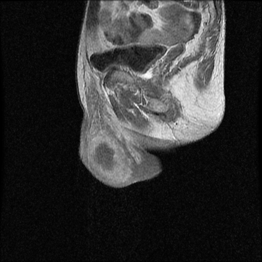 File:Necrotizing epididymo-orchitis with intra-testicular abscess (Radiopaedia 29397-29860 Sagittal T1 C+ 14).jpg