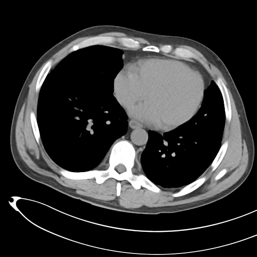 File:Necrotizing pancreatitis with acute necrotic collections (Radiopaedia 38829-41012 Axial non-contrast 2).png