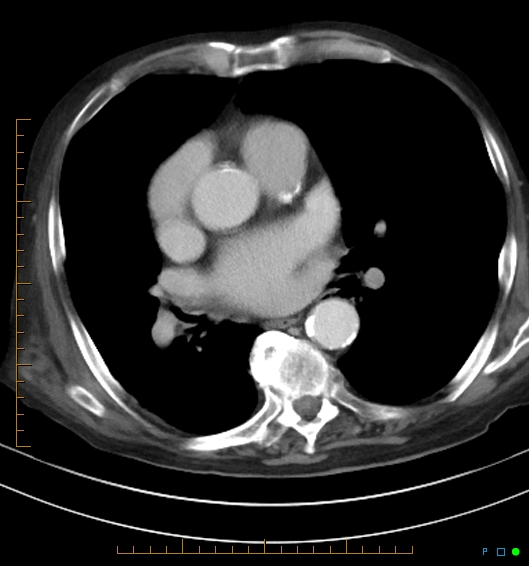 Necrotzing fasciitis due to a perforated adenocarcinoma of the splenic flexure (Radiopaedia 46930-51455 A 4).jpg