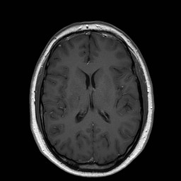 File:Neuro-Behcet's disease (Radiopaedia 21557-21505 Axial T1 C+ 13).jpg