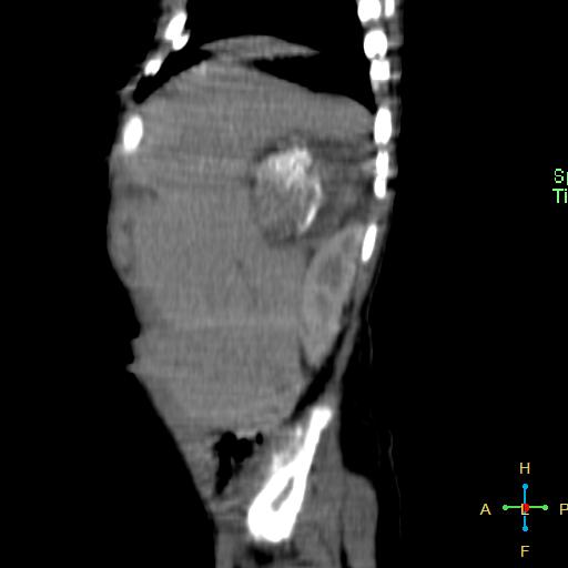 File:Neuroblastoma (Radiopaedia 24751-25016 C 26).jpg