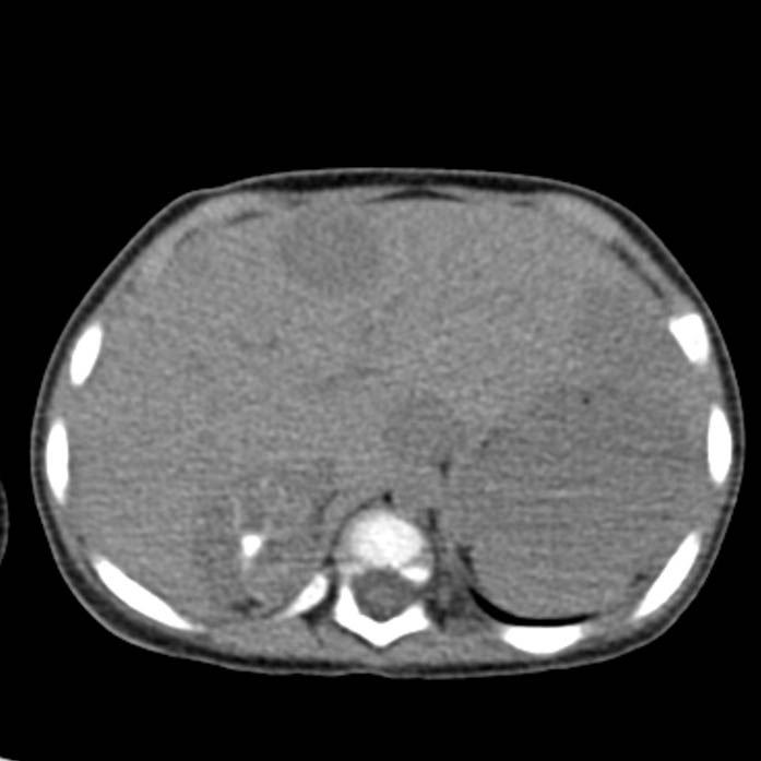 Neuroblastoma with skull metastases (Radiopaedia 30326-30960 Axial non-contrast 11).jpg