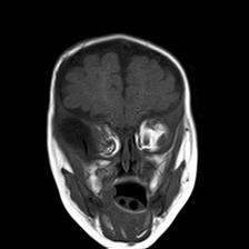 File:Neurofibromatosis type 1 (Radiopaedia 30089-30671 Coronal T1 7).jpg