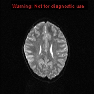 File:Neurofibromatosis type 1 with optic nerve glioma (Radiopaedia 16288-15965 Axial DWI 8).jpg