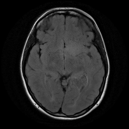 File:Neurofibromatosis type 2 (Radiopaedia 45229-49244 Axial FLAIR 9).png