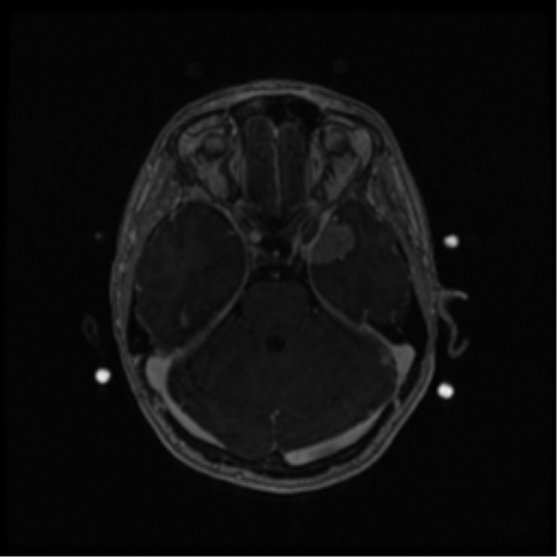 Neurofibromatosis type 2 (Radiopaedia 45229-49244 Axial T1 C+ 47).png