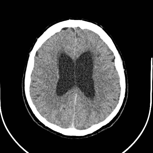 Neurofibromatosis type 2 (Radiopaedia 79097-92047 Axial non-contrast 39).jpg