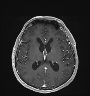 Neurofibromatosis type 2 (Radiopaedia 79097-92049 Axial T1 C+ 111).jpg