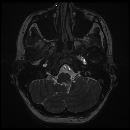 Neurofibromatosis type 2 - bilateral acoustic neuromata (Radiopaedia 40060-42566 Axial FIESTA 16).png