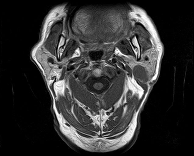 File:Non-Hodgkin lymphoma - parotid gland (Radiopaedia 71531-81890 Axial T1 13).jpg