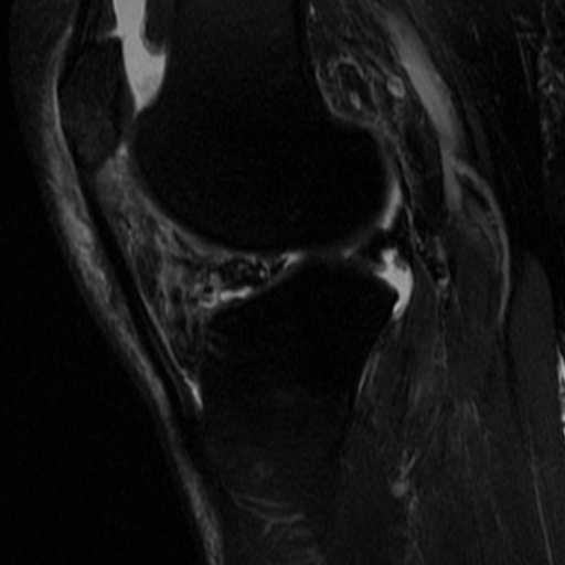File:Non-displaced patella fracture (Radiopaedia 15932-15582 Sagittal T2 fat sat 12).jpg