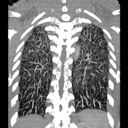 File:Non-small cell lung cancer with miliary metastases (Radiopaedia 23995-24193 Coronal lung window 12).jpg