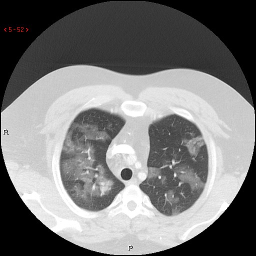 File:Non-specific interstitial pneumonitis (Radiopaedia 27044-27222 Axial lung window 43).jpg