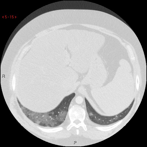 File:Non-specific interstitial pneumonitis (Radiopaedia 27044-27222 Axial lung window 6).jpg