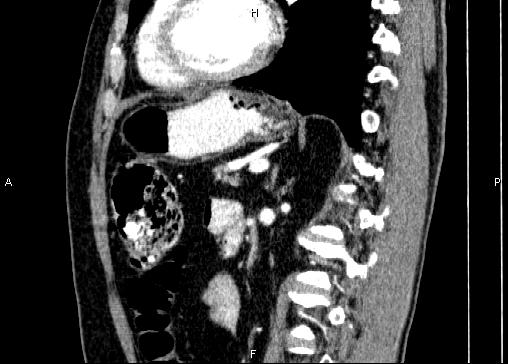 Non-syndromic pancreatic endocrine tumor (Radiopaedia 86958-103178 E 64).jpg