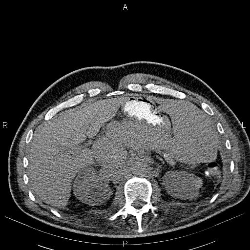 File:Non Hodgkin lymphoma in a patient with ankylosing spondylitis (Radiopaedia 84323-99621 Axial non-contrast 31).jpg