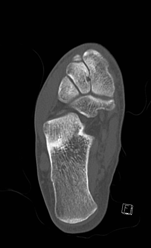 Normal CT of the ankle (Radiopaedia 47111-51658 Axial bone window 67).jpg