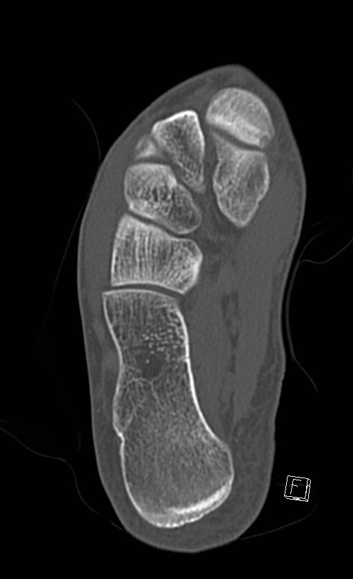 Normal CT of the ankle (Radiopaedia 47111-51658 Axial bone window 75).jpg